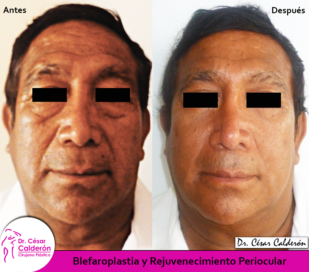 Blefaroplastia Clínica de la Belleza Trujillo 2