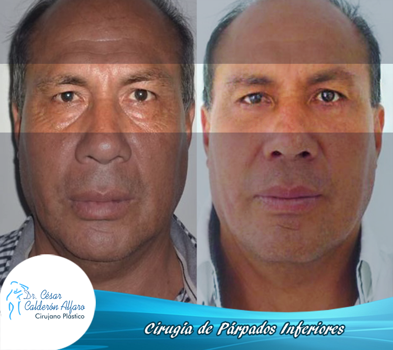 Blefaroplastia clínica de la belleza 2