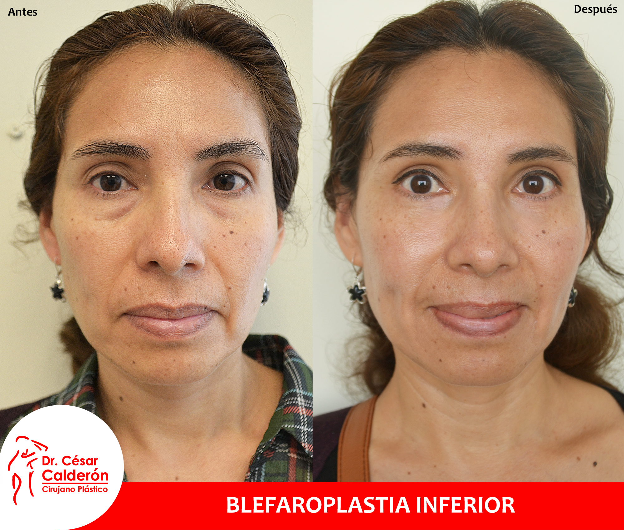 Clínica de la Belleza - Blefaroplastia-inferior-+-botox