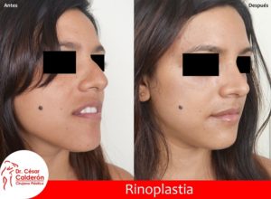 Rinoplastia 01