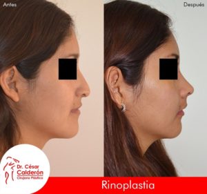 Rinoplastia 02