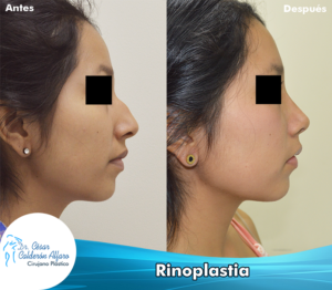 Rinoplastia 03