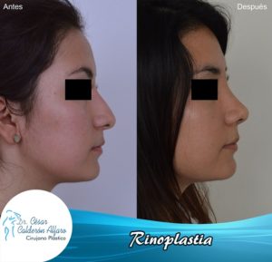 Rinoplastia 04