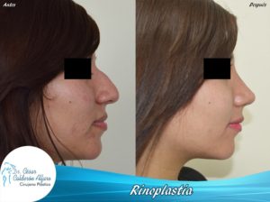 Rinoplastia 05