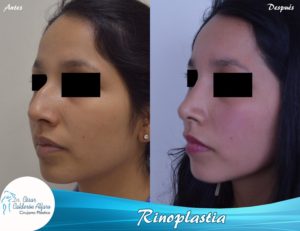 Rinoplastia 06