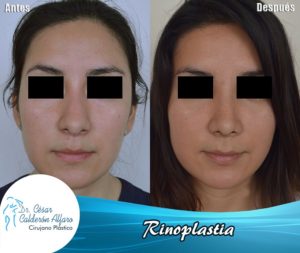 Rinoplastia 07