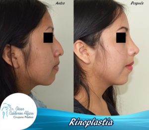 Rinoplastia 08