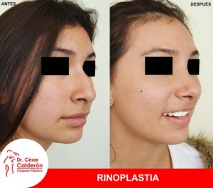 Rinoplastia 09