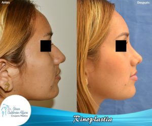 Rinoplastia 10