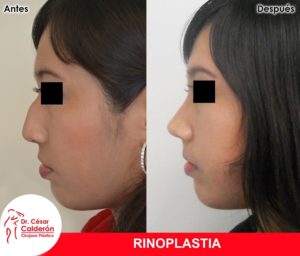 Rinoplastia 11