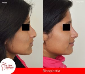 Rinoplastia 12