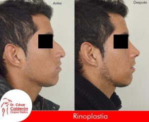 Rinoplastia 13