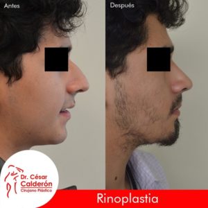 Rinoplastia 14