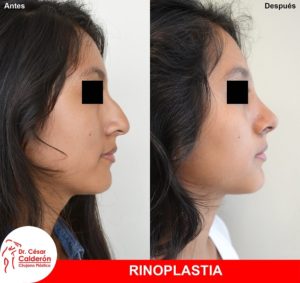 Rinoplastia 15