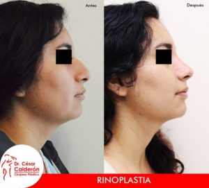 Rinoplastia 16