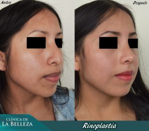 Rinoplastia 17