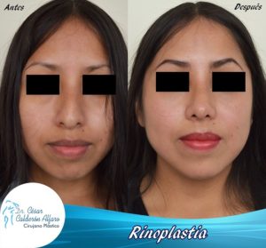 Rinoplastia 18