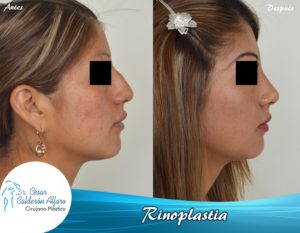 Rinoplastia 19