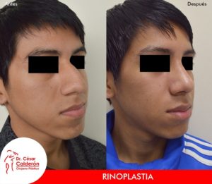 Rinoplastia 20