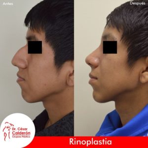 Rinoplastia 22