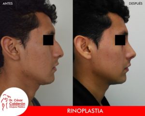 Rinoplastia 23