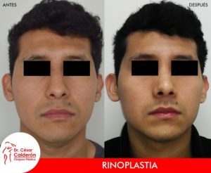 Rinoplastia 24