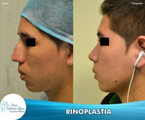 Rinoplastia 25