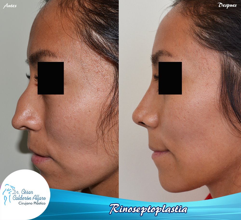Rinoplastia 02