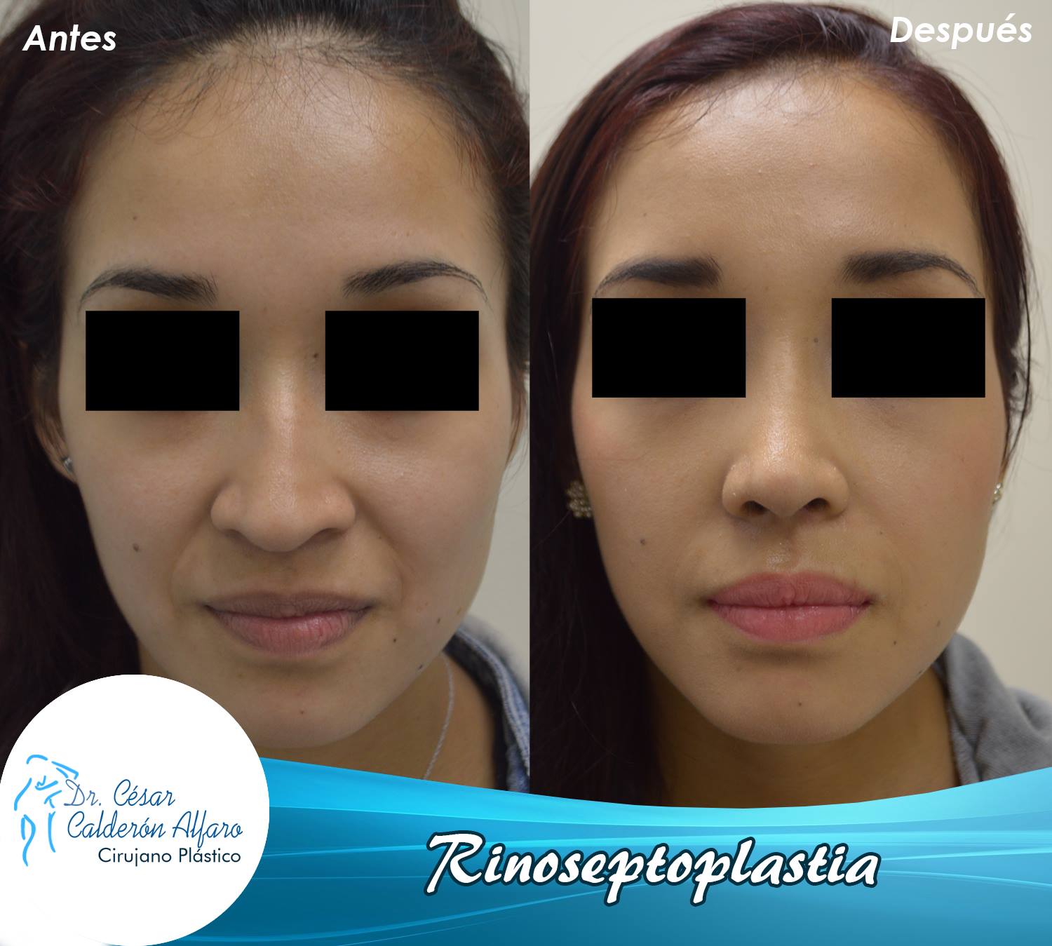 Rinoplastia 03